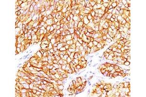 Formalin-paraffin human renal cell carcinoma stained with CAIX antibody (66. (CA9 抗体)
