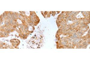 Immunohistochemistry of paraffin-embedded Human gastric cancer tissue using P2RY4 Polyclonal Antibody at dilution of 1:40(x200) (P2RY4 抗体)