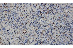 Immunohistochemistry of paraffin-embedded Human cervical cancer tissue using CD68 Polyclonal Antibody at dilution 1:30 (CD68 抗体)