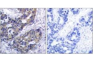 Immunohistochemistry analysis of paraffin-embedded human breast carcinoma tissue, using IRS-1 (Ab-312) Antibody. (IRS1 抗体  (AA 279-328))