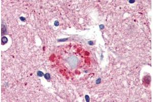 Human Brain, Cortex, Senile Plaque (formalin-fixed, paraffin-embedded) stained with Ubiquitin antibody ABIN462097 at 10 ug/ml followed by biotinylated goat anti-rabbit IgG secondary antibody ABIN481713, alkaline phosphatase-streptavidin and chromogen. (Ubiquitin 抗体)