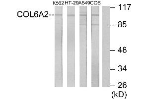 Immunohistochemistry analysis of paraffin-embedded human lung carcinoma tissue using Collagen VI α2 antibody. (COL6A2 抗体)