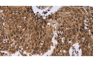 Immunohistochemistry of paraffin-embedded Human cervical cancer tissue using ERCC6L Polyclonal Antibody at dilution 1:30 (ERCC6L 抗体)