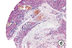 Immunhistochemistry image of OPN staining in paraffin sections of synovial tissue of pigmented villonodular synovitis (PVNS) patients. (Osteopontin 抗体  (AA 164-179))