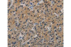Immunohistochemistry of Human liver cancer using CASP9 Polyclonal Antibody at dilution of 1:60 (Caspase 9 抗体)