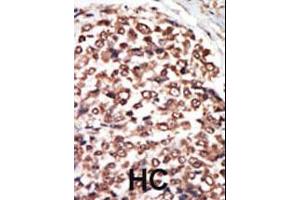 Formalin-fixed and paraffin-embedded human cancer tissue reacted with the primary antibody, which was peroxidase-conjugated to the secondary antibody, followed by AEC staining. (PRKD3 抗体  (C-Term))