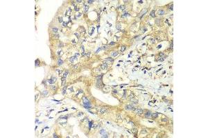 Immunohistochemistry of paraffin-embedded human liver cancer using TIMM17A antibody. (TIMM17A 抗体  (AA 1-171))