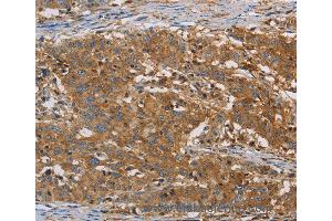 Immunohistochemistry of Human gastic cancer using CFL1 Polyclonal Antibody at dilution of 1:30 (Cofilin 抗体)