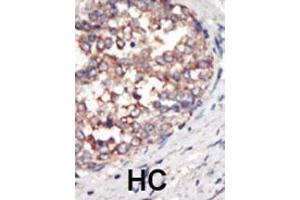 Formalin-fixed and paraffin-embedded human cancer tissue reacted with the primary antibody, which was peroxidase-conjugated to the secondary antibody, followed by AEC staining. (PIK3 gamma 抗体  (C-Term))