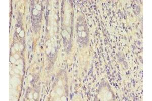 Immunohistochemistry of paraffin-embedded human colon cancer using ABIN7148658 at dilution of 1:100 (CKB 抗体  (AA 2-270))