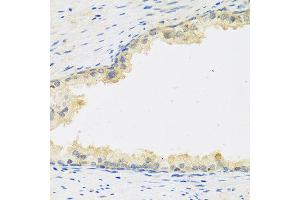 Immunohistochemistry of paraffin-embedded human prostate using LIF antibody at dilution of 1:100 (40x lens). (LIF 抗体)