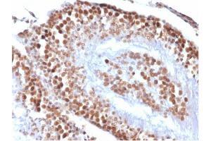 Immunohistochemistry (IHC) image for anti-Wilms Tumor 1 (WT1) antibody (ABIN6940904)