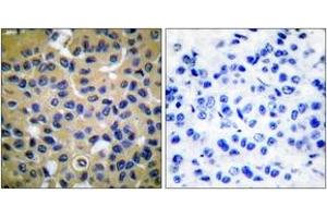 Immunohistochemistry analysis of paraffin-embedded human breast carcinoma tissue, using Collagen II Antibody. (COL2 抗体  (AA 101-150))