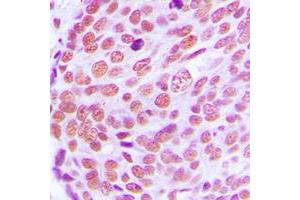 Immunohistochemical analysis of Lamin A/C staining in human breast cancer formalin fixed paraffin embedded tissue section. (Lamin A/C 抗体  (Center))