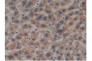 IHC-P analysis of Human Liver Cancer Tissue, with DAB staining. (LGALS8 抗体  (AA 1-317))