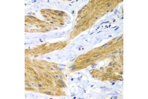 Immunohistochemistry of paraffin-embedded human gastric cancer using HRAS antibody. (HRAS 抗体)