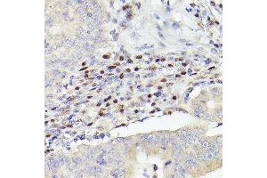 Immunohistochemistry of paraffin-embedded human colon carcinoma using MEF2A+MEF2C Rabbit mAb (ABIN1679049, ABIN1679050, ABIN7101495 and ABIN7101496) at dilution of 1:100 (40x lens). (MEF2A+MEF2C 抗体)