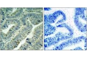 Immunohistochemistry analysis of paraffin-embedded human colon carcinoma, using Src (Phospho-Tyr418) Antibody. (Src 抗体  (pTyr419))