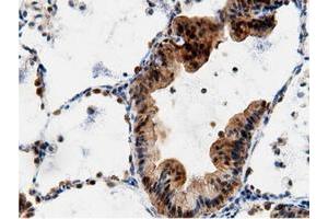 Immunohistochemical staining of paraffin-embedded Adenocarcinoma of Human breast tissue using anti-AK5 mouse monoclonal antibody. (Adenylate Kinase 5 抗体)