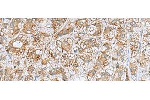 Immunohistochemistry of paraffin-embedded Human liver cancer tissue using NQO2 Polyclonal Antibody at dilution of 1:70(x200) (NQO2 抗体)
