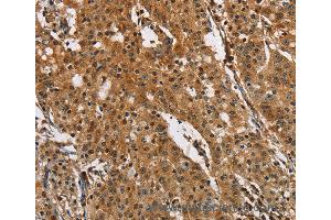 Immunohistochemistry of Human gastic cancer using PTK6 Polyclonal Antibody at dilution of 1:40 (PTK6 抗体)