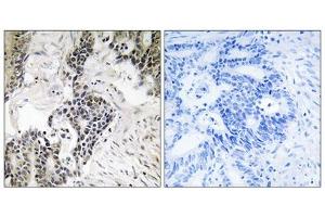 Immunohistochemistry analysis of paraffin-embedded human colon carcinoma tissue, using CDC25C (Phospho-Ser198) antibody. (CDC25C 抗体  (pSer198))
