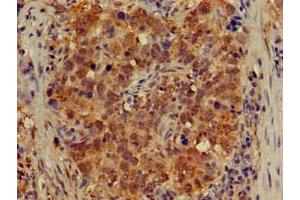 Immunohistochemistry of paraffin-embedded human pancreatic cancer using ABIN7149021 at dilution of 1:100 (ATG4B 抗体  (AA 350-400))