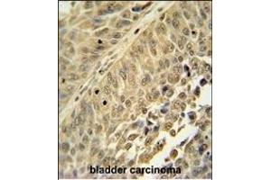 HNRNPC antibody (C-term) (ABIN654685 and ABIN2844378) immunohistochemistry analysis in formalin fixed and paraffin embedded human bladder carcinoma followed by peroxidase conjugation of the secondary antibody and DAB staining. (HNRNPC 抗体  (C-Term))