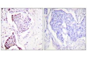 Immunohistochemistry analysis of paraffin-embedded human breast carcinoma tissue, using Ubiquitin antibody. (Ubiquitin 抗体  (Internal Region))