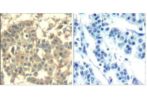 Immunohistochemical analysis of paraffin-embedded human breast carcinoma tissue using Met (Ab-1003) Antibody (E021548). (c-MET 抗体)