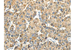 The image on the left is immunohistochemistry of paraffin-embedded Human liver cancer tissue using ABIN7131400(TMPRSS11E Antibody) at dilution 1/30, on the right is treated with fusion protein. (TMPRSS11E 抗体)