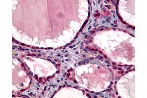 Anti-TSH Receptor / TSHR antibody IHC of human Thyroid, Follicular Carcinoma. (TSH receptor 抗体  (C-Term))