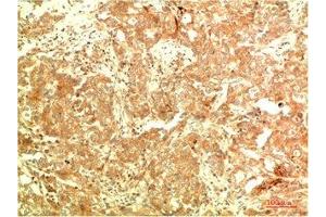 Immunohistochemical analysis of paraffin-embedded Human Breast Carcinoma Tissue using ATG5 Mouse mAb diluted at 1:2000 (ATG5 抗体)
