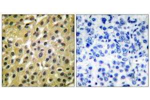 Immunohistochemical analysis of paraffin-embedded human breast carcinoma tissue, using MDM2 antibody (ABIN5976454). (MDM2 抗体  (C-Term))