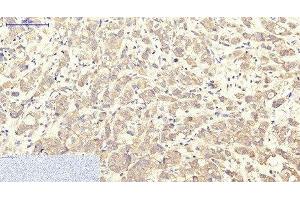 Immunohistochemistry of paraffin-embedded Human breast cancer tissue using ITGA2B Monoclonal Antibody at dilution of 1:200. (Integrin Alpha2b 抗体)