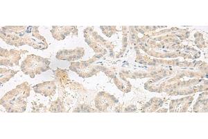 Immunohistochemistry of paraffin-embedded Human thyroid cancer tissue using EPRS Polyclonal Antibody at dilution of 1:60(x200) (EPRS 抗体)
