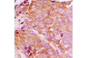 Immunohistochemical analysis of YTHDF1 staining in human breast cancer formalin fixed paraffin embedded tissue section. (YTHDF1 抗体  (N-Term))