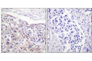 Immunohistochemical analysis of paraffin-embedded human breast carcinoma tissue using p90 RSK (Phospho-Thr573) antibody (left)or the same antibody preincubated with blocking peptide (right). (RPS6KA1 抗体  (pThr573))