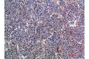 Immunohistochemical analysis of paraffin-embedded human-kidney-cancer, antibody was diluted at 1:200. (EGF 抗体  (AA 1000-1060))