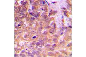 Immunohistochemical analysis of STAT5 staining in human breast cancer formalin fixed paraffin embedded tissue section. (STAT5A 抗体  (Center))