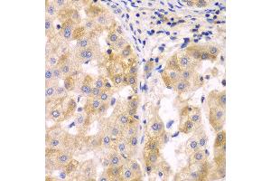 Immunohistochemistry of paraffin-embedded human liver cancer using SULT2B1 antibody at dilution of 1:100 (x40 lens). (SULT2B1 抗体)