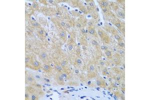 Immunohistochemistry of paraffin-embedded human liver cancer using FURIN antibody at dilution of 1:100 (40x lens). (FURIN 抗体)