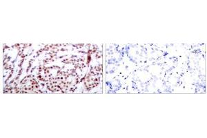 Immunohistochemical analysis of paraffin-embedded human breast carcinoma tissue using ATF-2 (phospho-Thr73 or 55) antibody (E011032). (ATF2 抗体  (pThr55, pThr73))