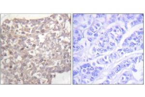 Immunohistochemistry analysis of paraffin-embedded human breast carcinoma tissue, using Tubulin gamma antibody. (TUBG1 抗体  (C-Term))