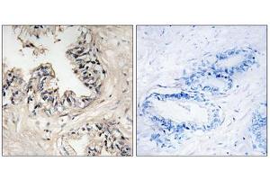 Immunohistochemistry analysis of paraffin-embedded human breast carcinoma tissue using MRPS36 antibody. (MRPS36 抗体  (N-Term))