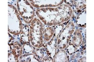 Immunohistochemical staining of paraffin-embedded Adenocarcinoma of ovary tissue using anti-LIPG mouse monoclonal antibody. (LIPG 抗体)