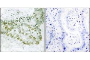 Immunohistochemistry analysis of paraffin-embedded human lung carcinoma tissue, using Hic-5 (Ab-60) Antibody. (TGFB1I1 抗体  (AA 31-80))