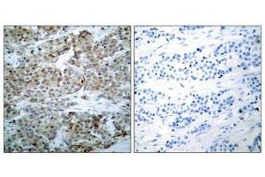 Immunohistochemical analysis of paraffin-embedded human breast carcinoma tissue using BAD(Phospho-Ser112) Antibody(left) or the same antibody preincubated with blocking peptide(right). (BAD 抗体  (pSer112))