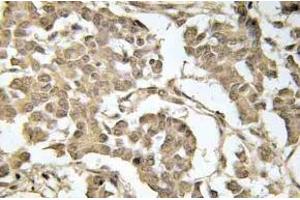 Immunohistochemistry (IHC) analyzes of p-eIF2alpha in paraffin-embedded human breast carcinoma tissue. (EIF2S1 抗体  (pSer51))