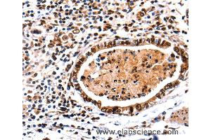 Immunohistochemistry of Human stomach cancer using DNMT3A Polyclonal Antibody at dilution of 1:65 (DNMT3A 抗体)